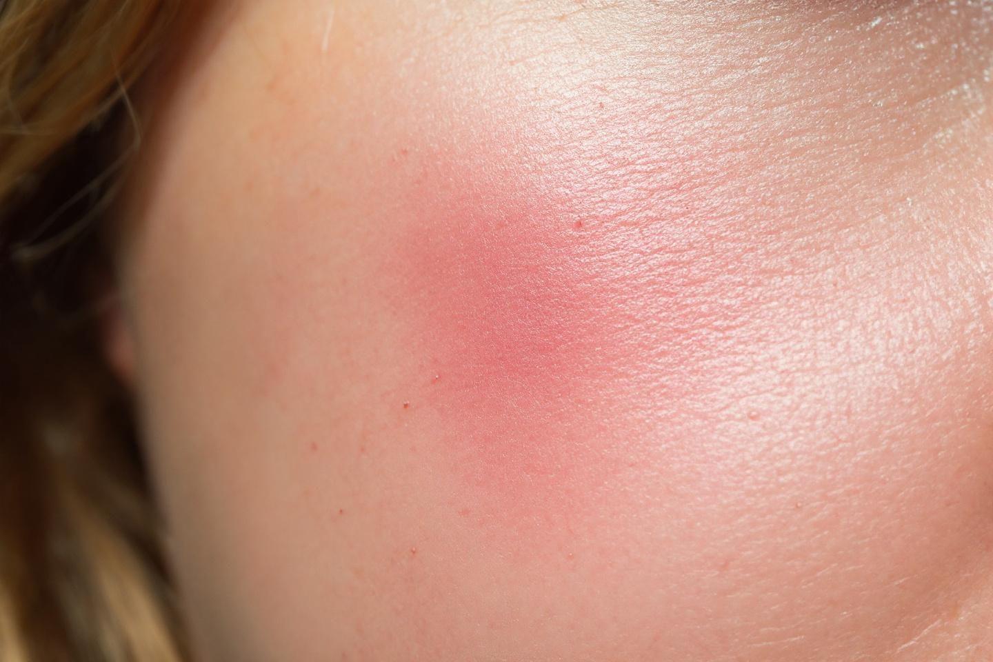 Mésothérapie : traitement efficace des blessures du sportif